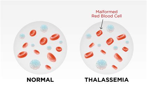 Thalassaemia .